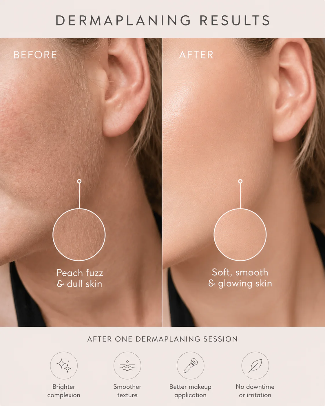 Dermaplaning-tulokset ennen ja jälkeen